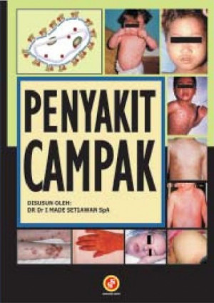 Image of Penyakit campak